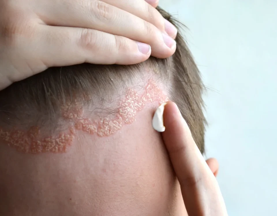 علائم و درمان انواع بیماری پوستی